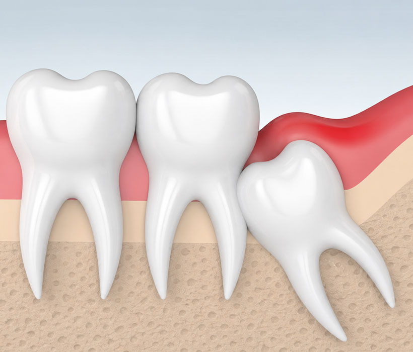 Wisdom Tooth Removal